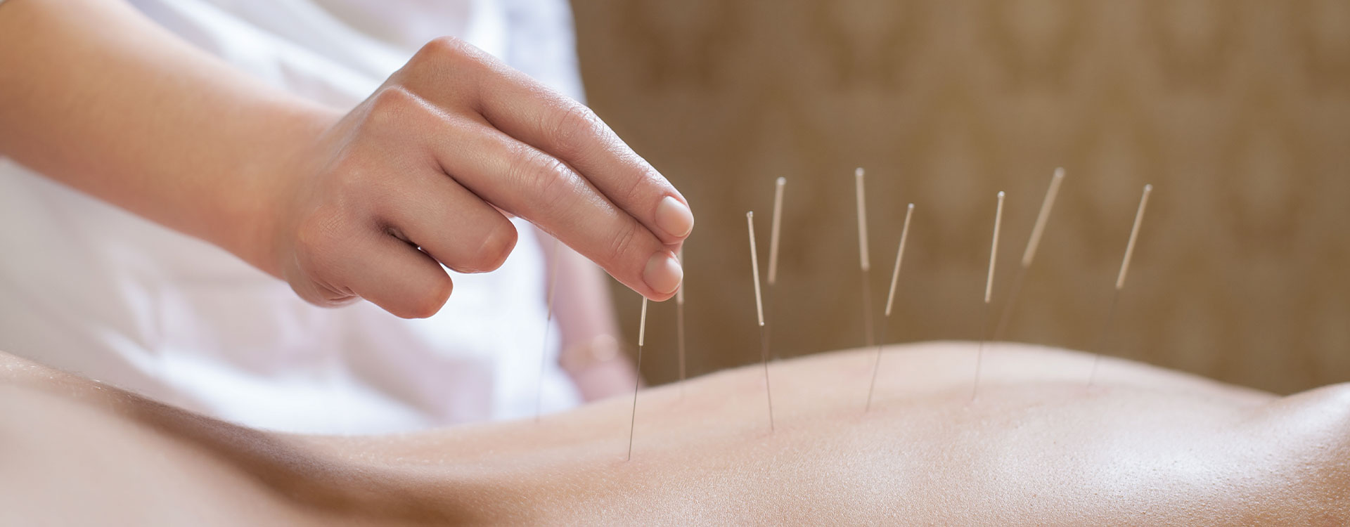 physiotherapist performing acupuncture in Calgary